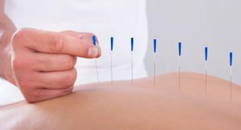 Acupuncture Alternative Therapy