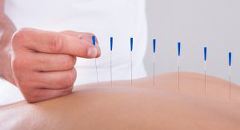 Acupuncture Alternative Therapy