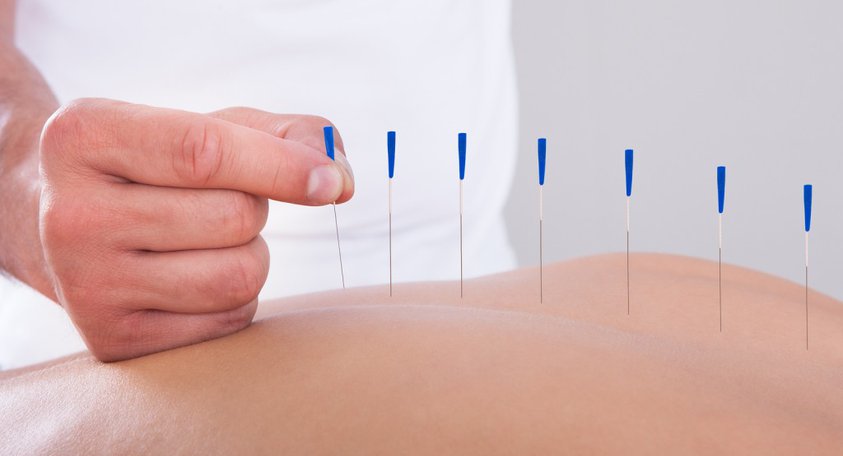 Acupuncture needles along the spine