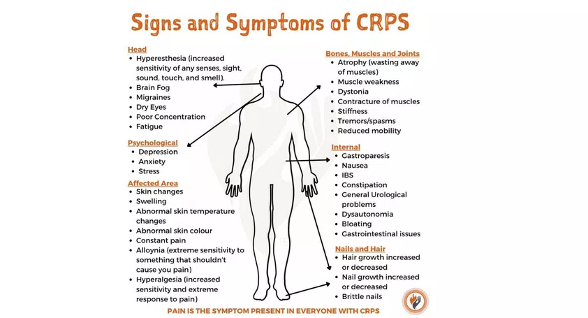 CRPS Symptoms | CRPS Signs | RSD Signs | RSD Symptoms