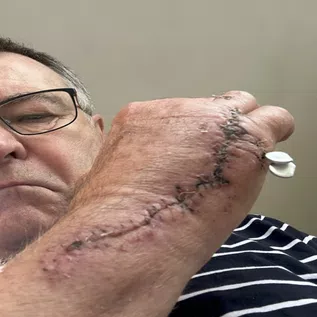 Ken's CRPS Story - Burning Nights