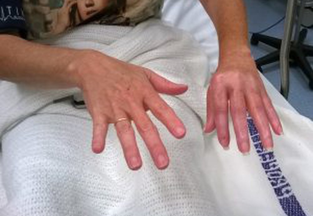 Sharon’s CRPS Story | contractured fingers