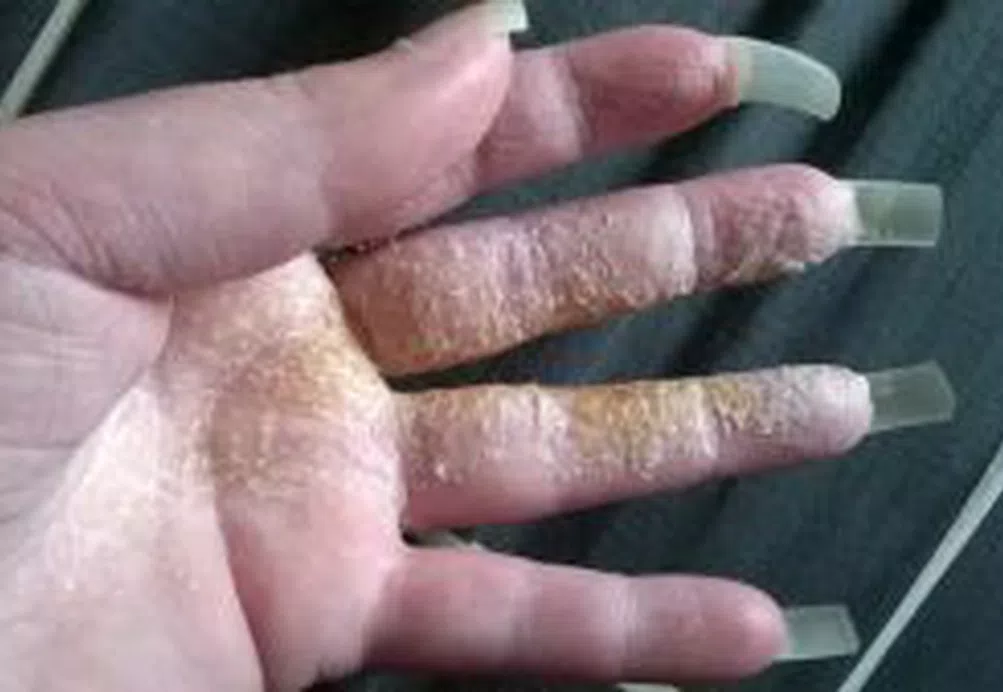 Sharon’s CRPS Story