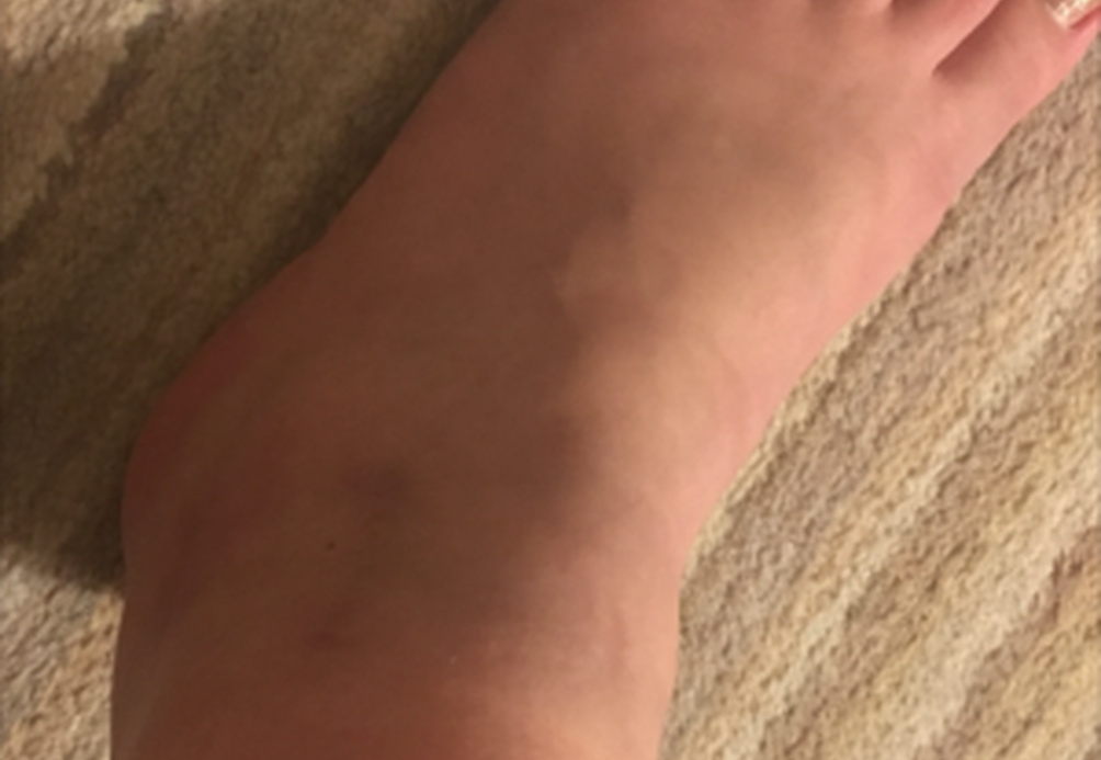 Jessica's CRPS story - ankle today