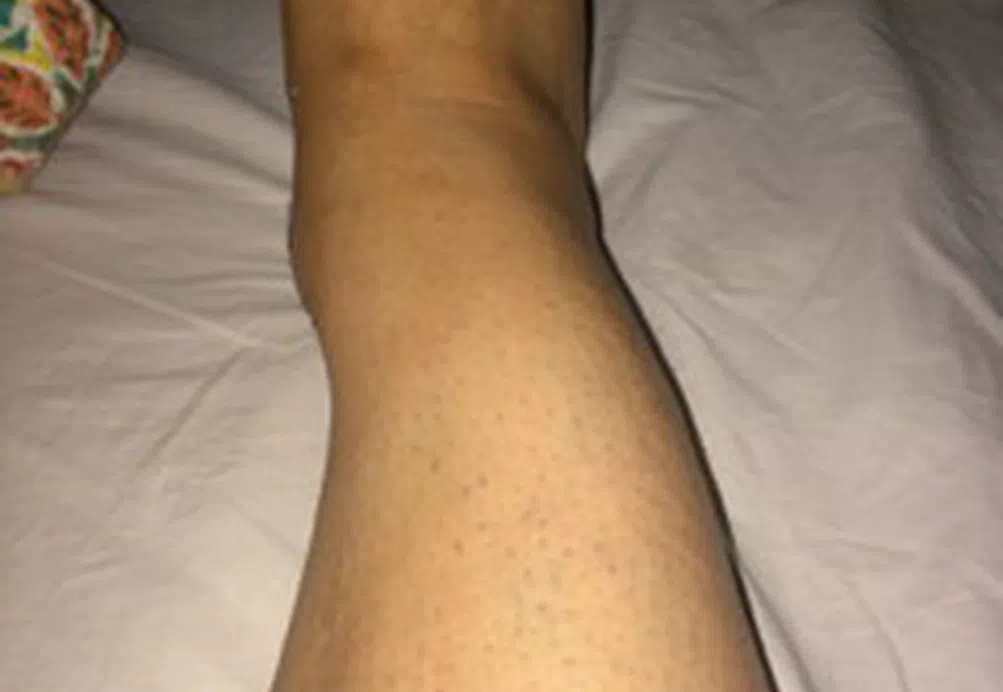 Janice’s CRPS Story 3 2014-06-22