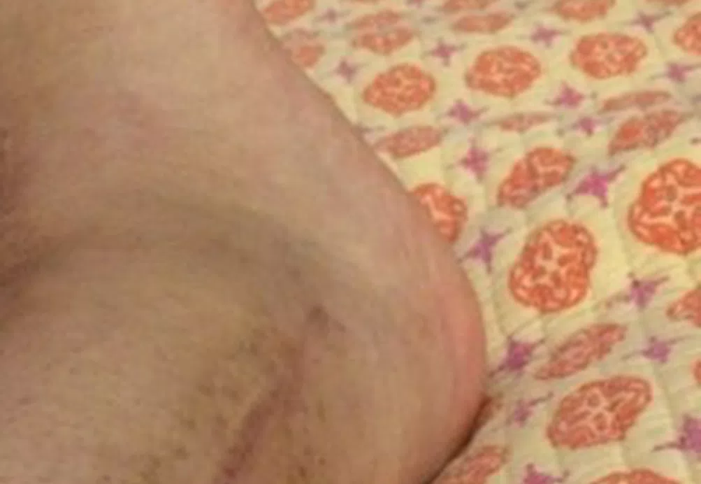 Janice’s CRPS Story 9 2015-02-14