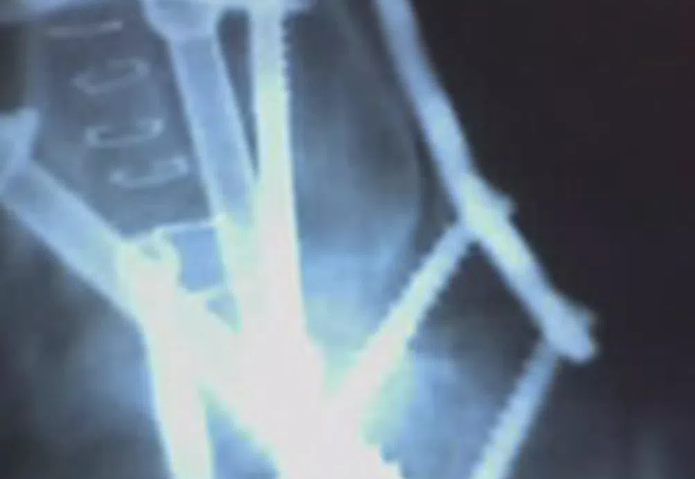 Sherri CRPS Story - Ankle X-ray