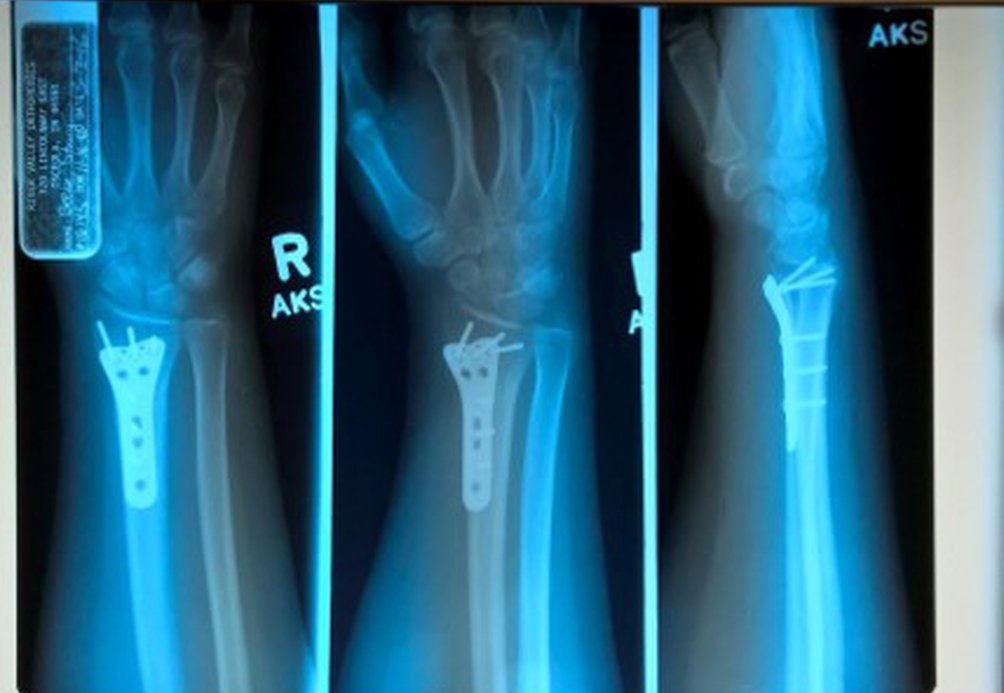 Read Stacey's CRPS Story and how she developed complex regional pain syndrome from an injury in March 2016. This is Stacey's x-ray from when she damaged her wrist