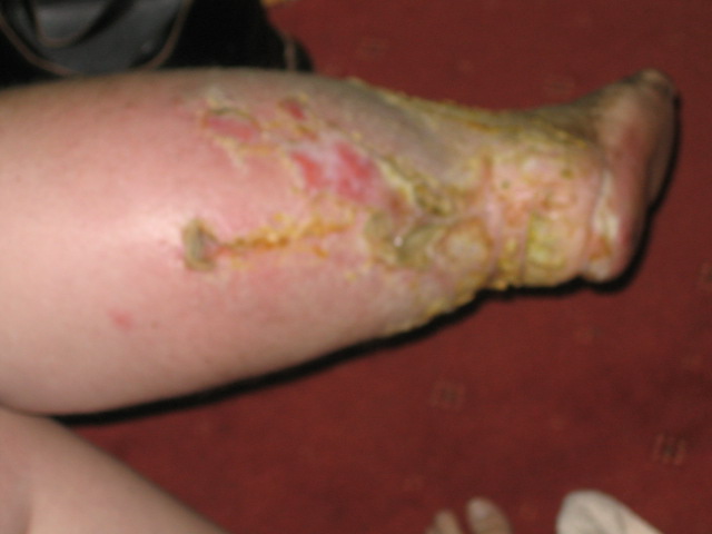 Poor skin, open ulcers, massive swelling on the back of the leg and whole of foot 8 months prior to amputation