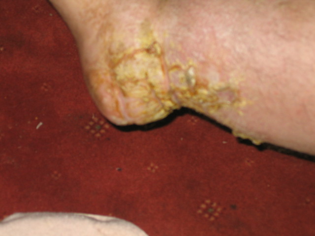 Final Stage ischaemia on foot and hair growth
