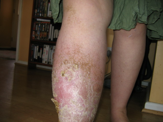 Limb with severe skin breakdown 6 months prior to amputation just before surgery for debridement that failed