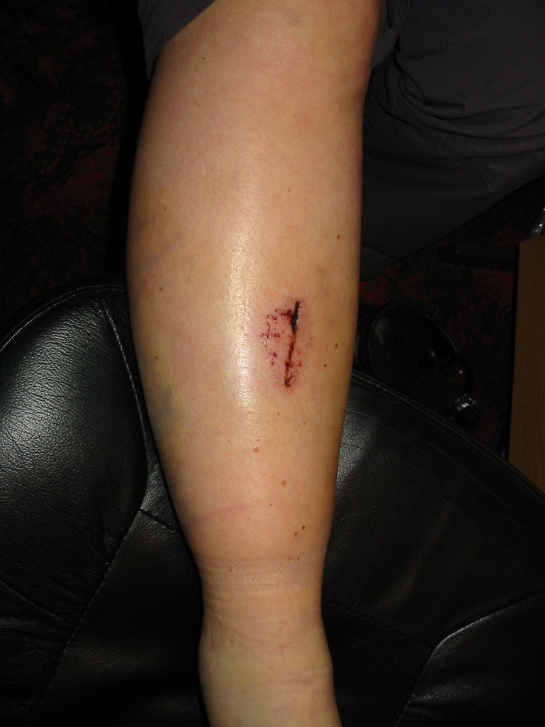 Image following an accident where the leg has immediately swollen and the skin has split