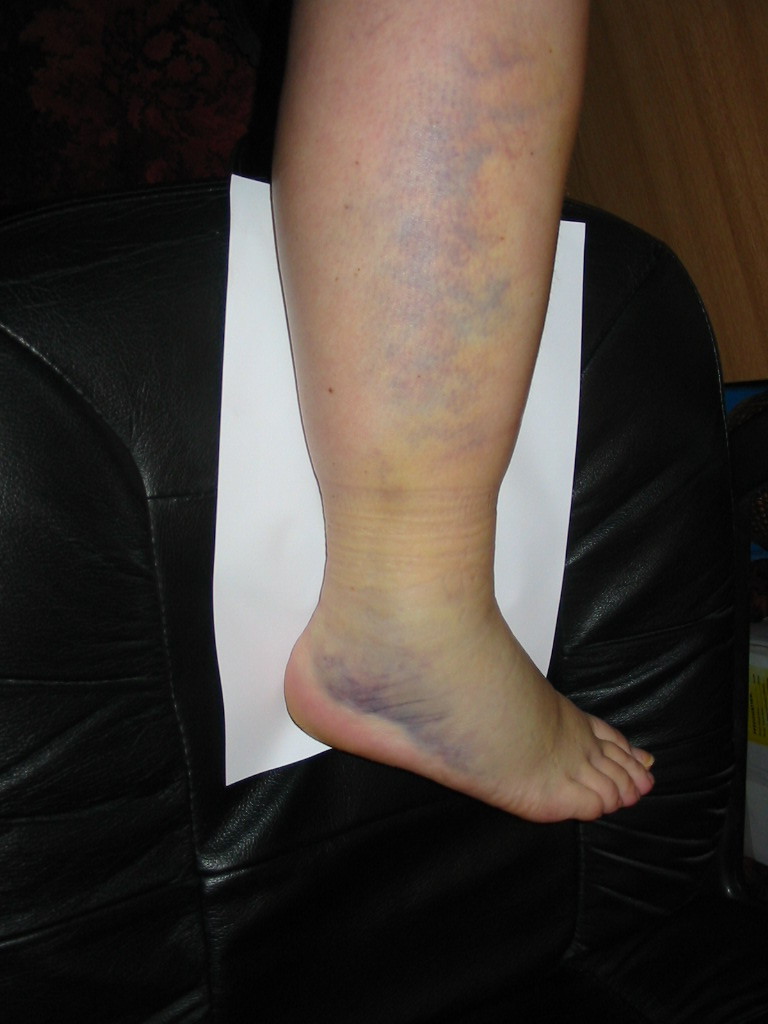 Our Founder - Limb 3 weeks post accident with bruising & swelling all up the leg from toes to knee