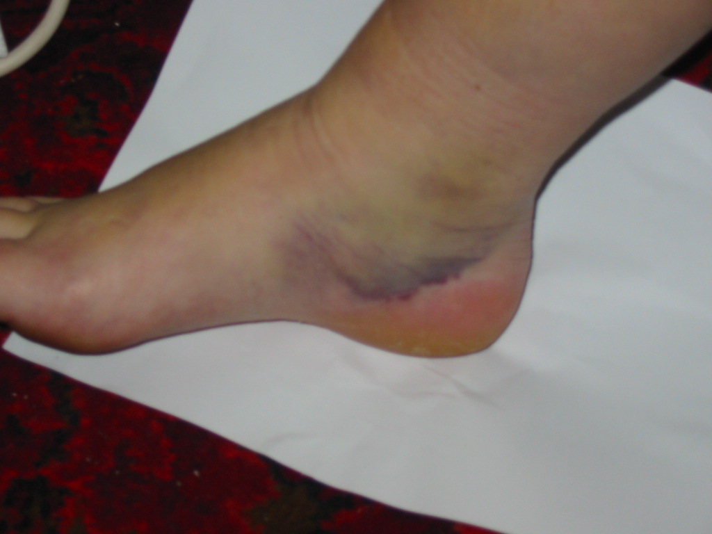 1 week post accident with severe bruising and swelling