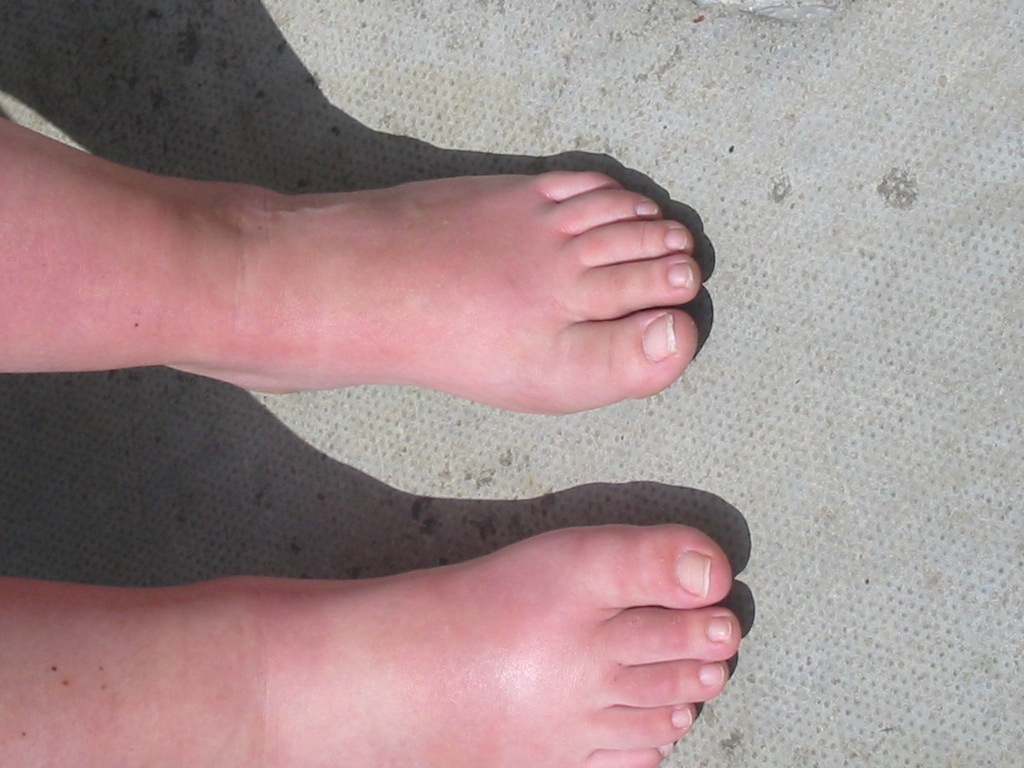 Stage 1 limb comparison showing swelling, colour, skin, nails & temperature changes