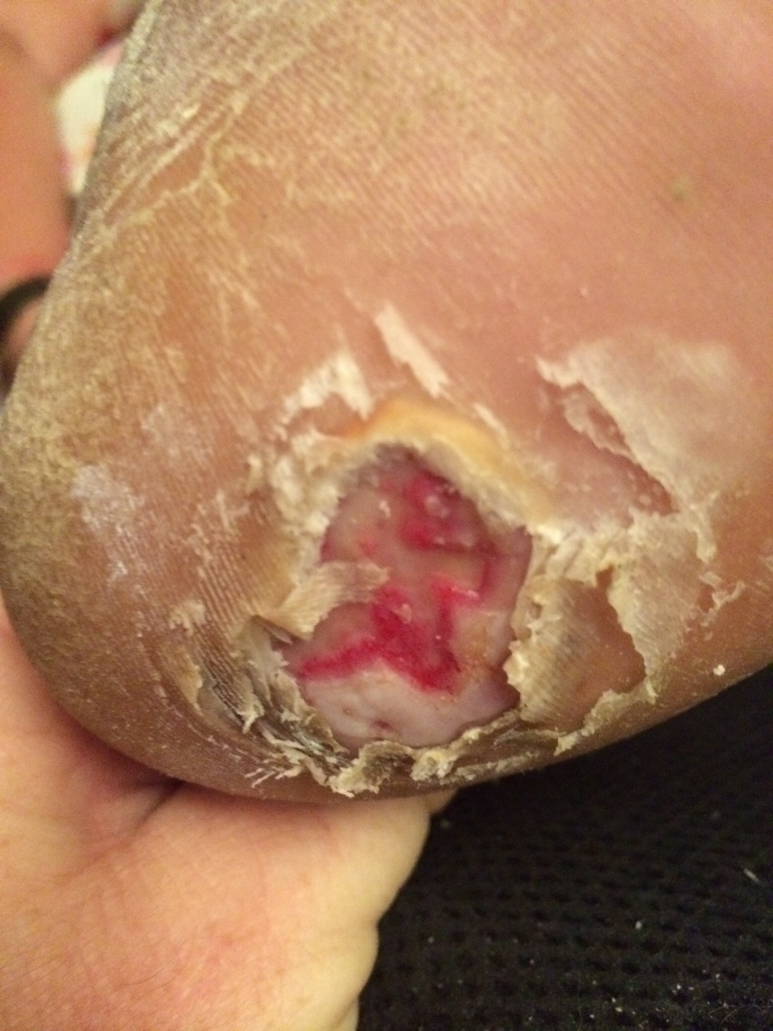 Left heel with ulceration down several layers of skin