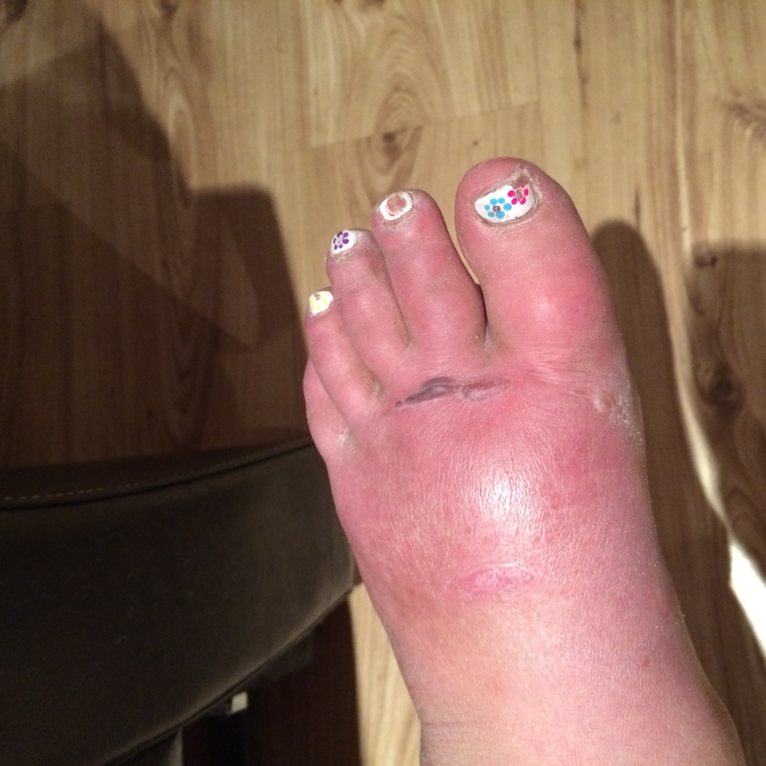 Stage 1 & 2 the skin is swollen with colour & temperature changes with blisters forming near the base of the toes