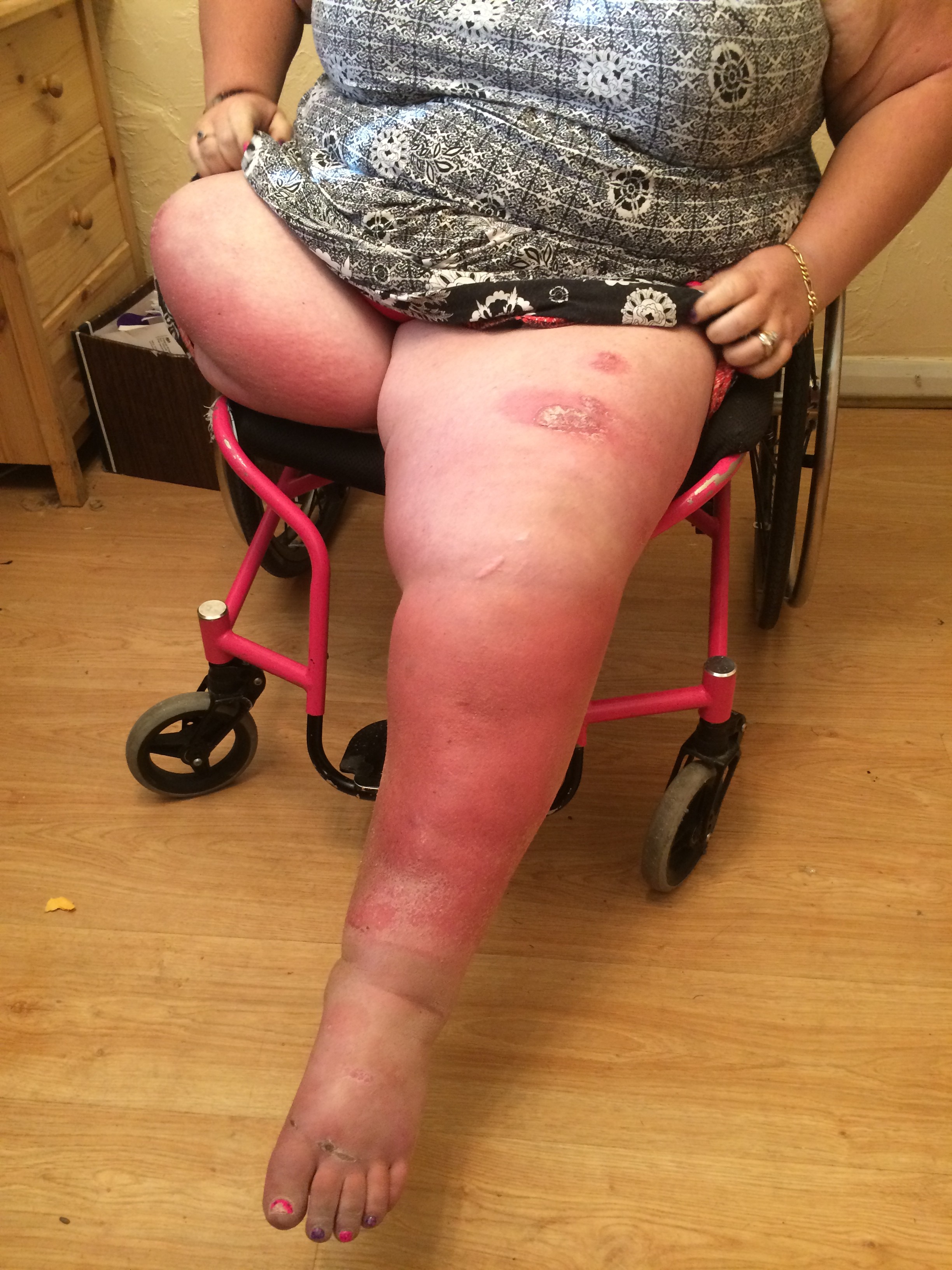 Left leg and stump redness, temperature changes in both sides