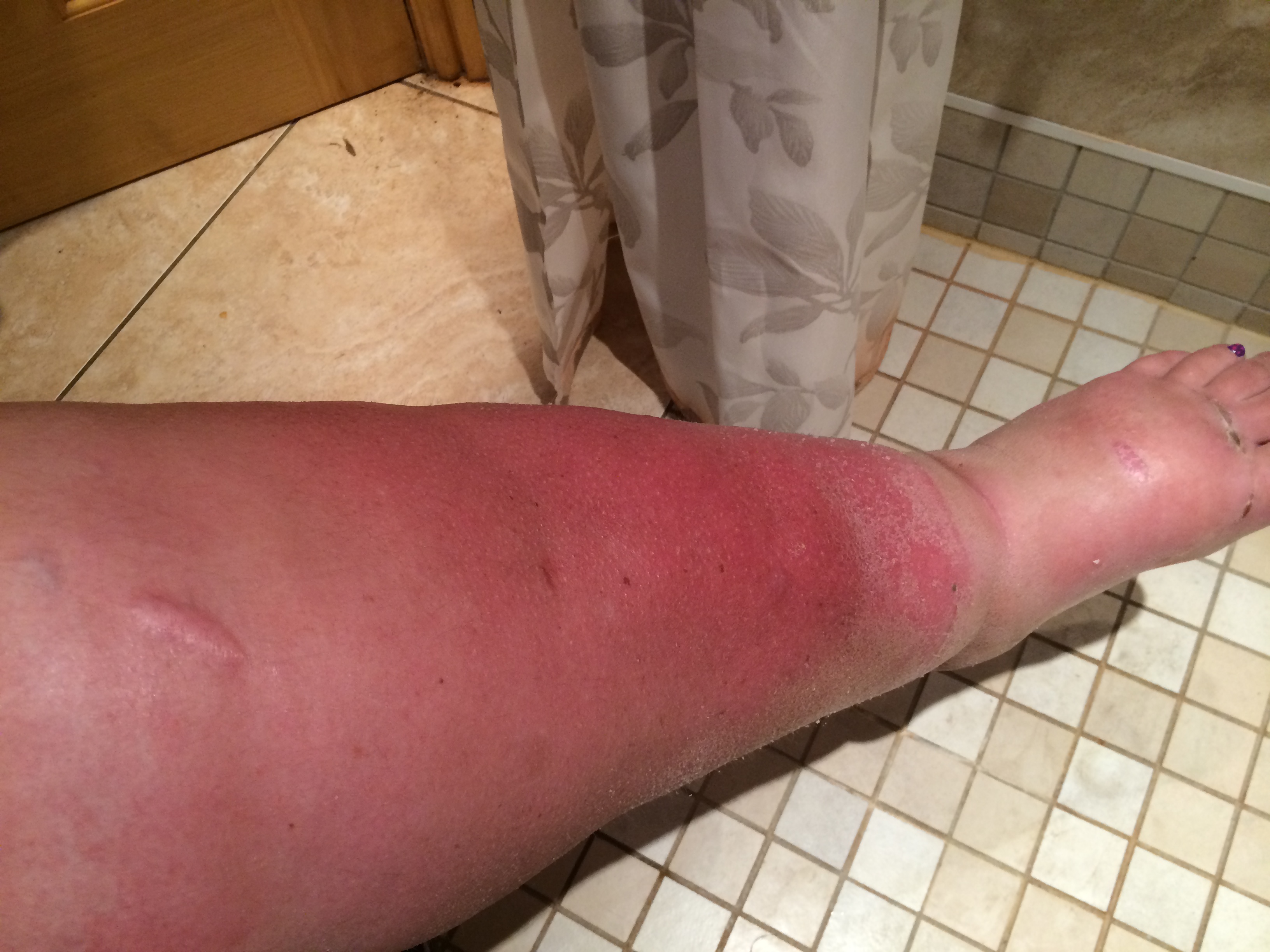 Left CRPS leg changing colour & temperature. Hair loss has begun