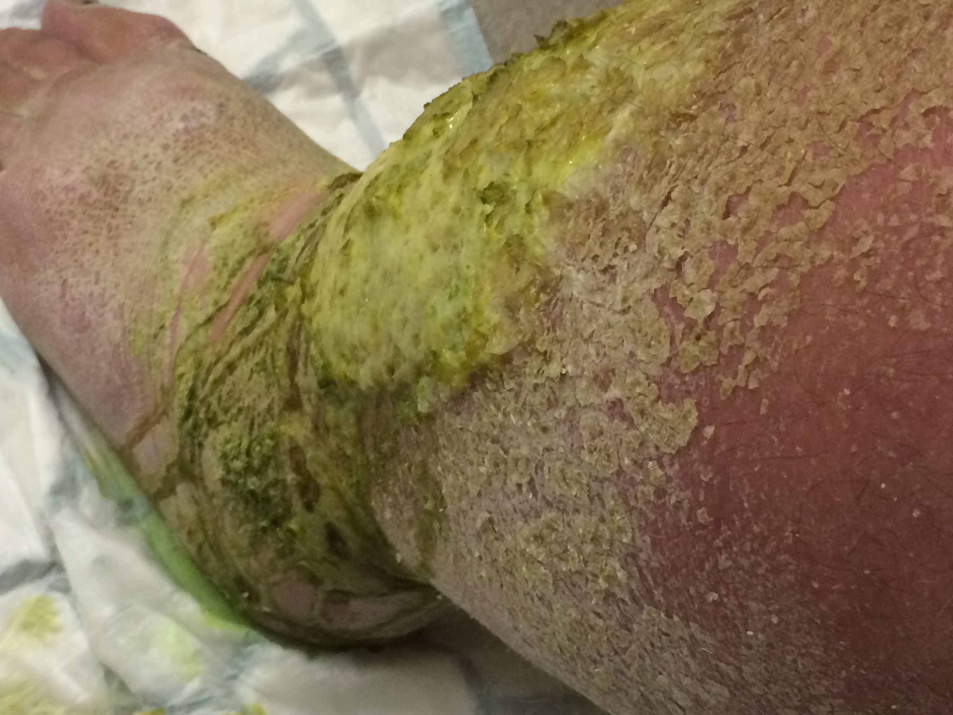 Left Leg close side view 15 December 2014 - 2 hours before Above Knee Amputation surgery at Manchester Royal Infirmary. very dry, cracked, stretched & flaky skin at front, side & back of leg and foot. Green grass-like colour of the wet area weeping down towards the foot causing chapped fold of the ankle both front and back.Hair growth, colour changes and the leg was extremely hot to go near. Allodynia in all areas of the leg was present as was extreme oedema (edema in US English) (swelling.)