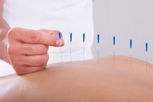 Acupuncture Alternative Therapy showing needles along the spineAcupuncture Alternative Therapy showing needles along the spine