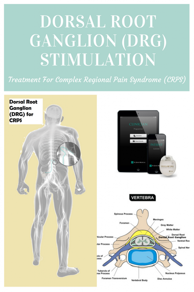 Dorsal Root Ganglion (DRG) Stimulation Treatment for Complex Regional Pain Syndrome (CRPS)
