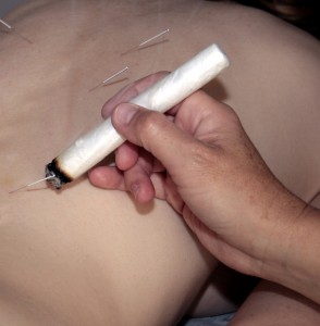 Moxibustion being done during an acupuncture treatment. Moxi is a herb usually in stick form which can be burned over acupuncture points to create heat in the area.